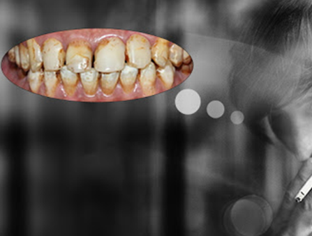 Nói “KHÔNG” với thuốc lá để bảo vệ răng miệng của bạn và những người xung quanh!